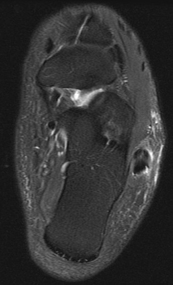 Figure 2 for case Peroneus brevis split tear